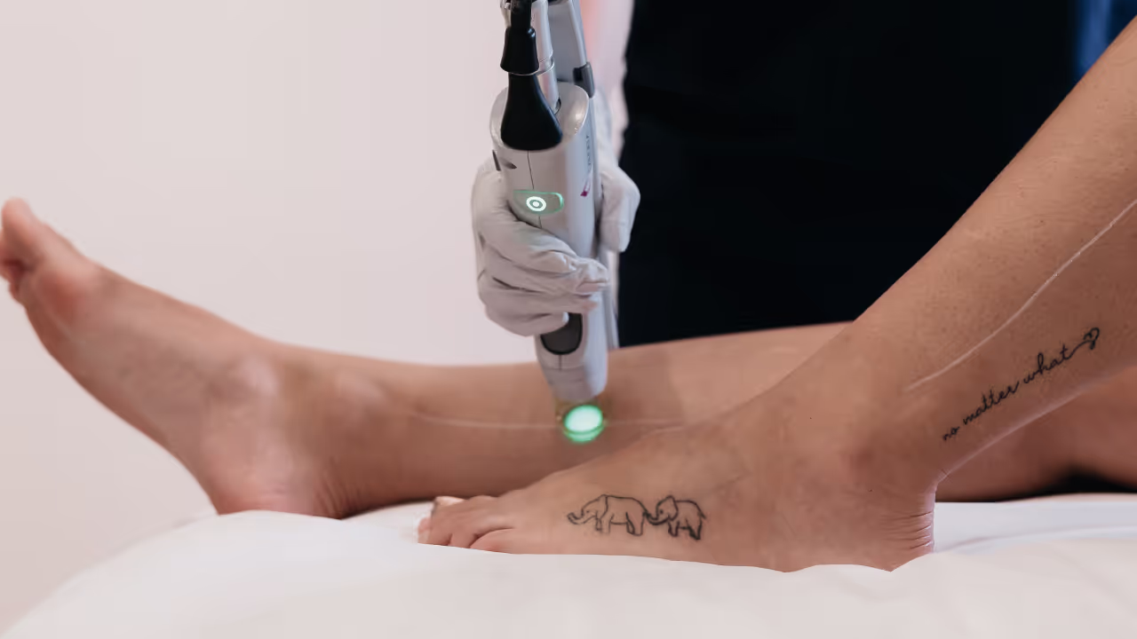 Laserová epilace v MUSE